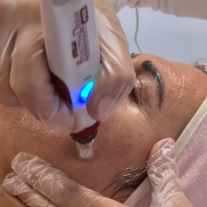 Microneedling C-vitamin therapy